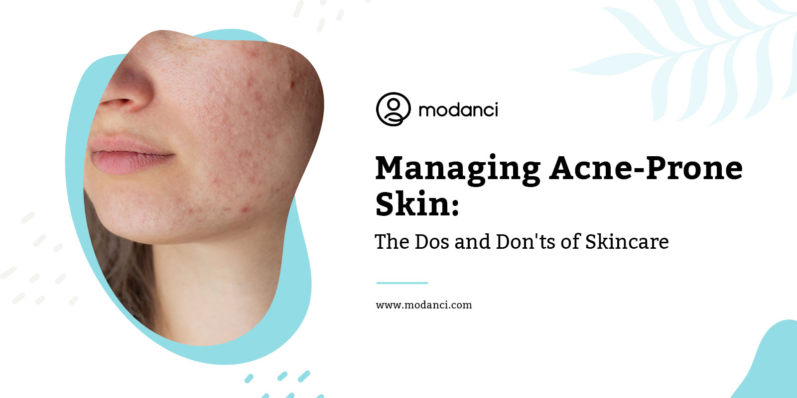 managing acne prone skin