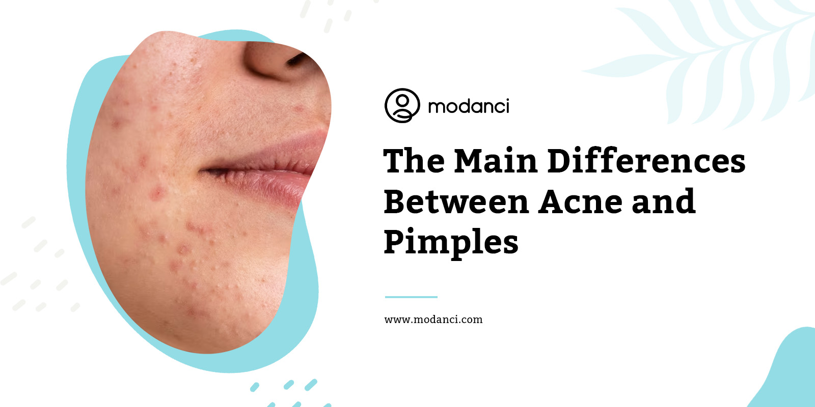 acne and pimple difference